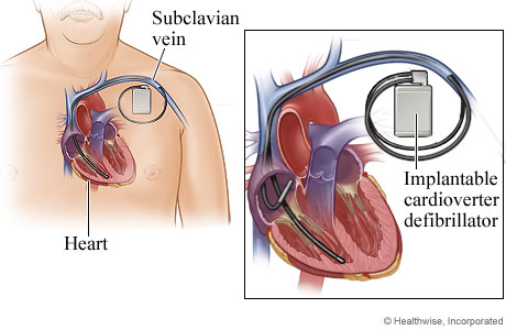 Bir damar yoluyla kalbe bağlanan ve bir ya da iki teli olan ICD doktor tarafından göğse yerleştirilir.