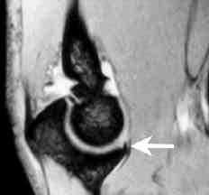 78 Acta Orthop Traumatol Turc Suppl Stabil, MRG de evre 1-2 olarak de erlendirilen lezyonlar eklemin dinlendirilmesi ile genellikle iyil e fl i r. Ancak, iyileflme bir y la kadar uzayabilir.