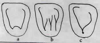 *Lingual fossada 3 form görülebilir: a) Hiçbir lingual sırt içermeyen düz form b) 1,2 veya 3 adet lingual sırt içeren form c) lingual sırtların olmadığı, marginal sırtların kuvvetlice