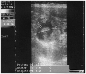 44 A B C Şekil 1: Yapılan ultrasonografik muayenelerde (A) ekstra