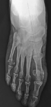 [6] Juvenil ve adölesan hastalardaki şiddetli bunyon deformitesinin düzeltilmesine yönelik açık kama osteotomisini ilk olarak Trethowan 1923 yılında tarif etmiştir.