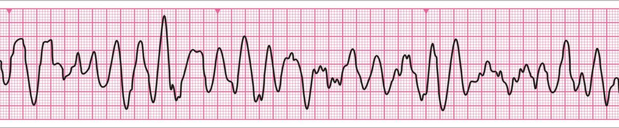 Şok uygulanan (VF) Garip - düzensiz dalga Tanımlanabilir QRS kompleksi yok Frekans ve amplitüdü değişken