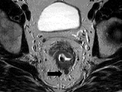 Bununla irlikte endolüminal sargının 3 cm. lik alanı göstereilmesi nedeniyle üst rektum yerleşimli tümörler, lateral pelvik ve inferior mezenterik lenf nodülleri yeteri kadar değerlendirilememektedir.