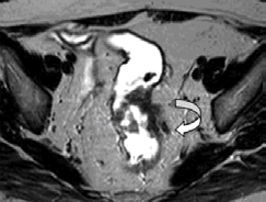() Aynı hastanın daha inferiordan geçen aksiyal kesitlerinde tümör anteriorda mezorektal fasyayı tutmuştur (oklar). (c) Histolojik kesitte tümör depoziti (oklar).