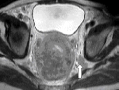 Şekil 5: 62 yaşında, kadın, T3 evre rektum kanseri. T2 ağırlıklı aksiyel kesitte tümör rektum duvar ütünlüğünü ozarak mezorektal yağlı alan içine uzanım gösteriyor. Tümör mezorektal fasyaya 1 cm.
