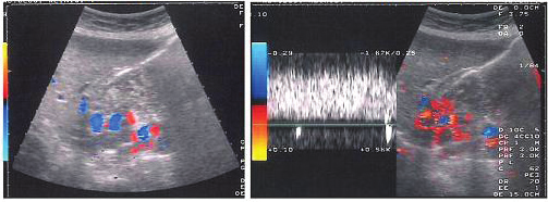 izlendi (Resim 4. a,b). Karaciğer konturlarının hafif düzensiz olduğu ve mikrolobülasyonlar gösterdiği saptandı. Venöz kollateral yapılar ve lokalizasyonları net olarak izlenebildi.