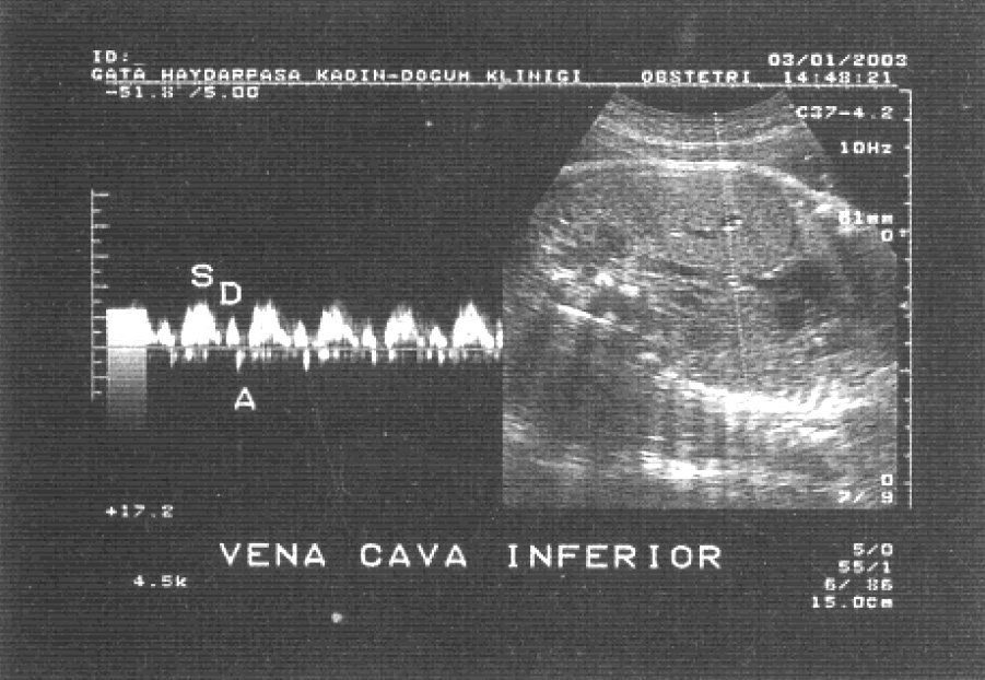 Ercüment Müngen, Fetal Venöz Doppler 7 7 k n zamanda yap lan s n rl say daki çal flma, progresif UGR sürecinde önce venöz Doppler bulgular - n n anormalleflti ini, bundan sonra kalp at m h z de