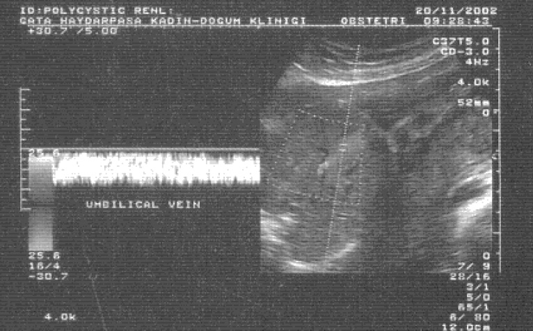 10 Resim 6. Intraabdominal umbilikal vende normal ak m h z dalga formu.