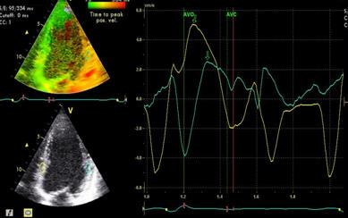 Şekil 2.4. Kalp siklusu boyunca miyokart doku Doppler hızlarının grafiksel gösterilmesi. Sistolde lateral duvarın pik sistolik hızı (yeşil) septal duvarın (sarı) pik sistolik hızına göre gecikmiştir.