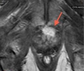 MRI Negatif prostat biyopsisine