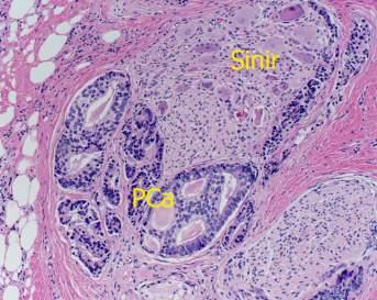 EKY ve Perinöral invazyon EKY İğne biyopsilerinde nadir görülür pt3