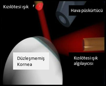 Resim-2: ORA çalışma prensibi Tüm bu süreç boyunca korneanın düzleşmesi