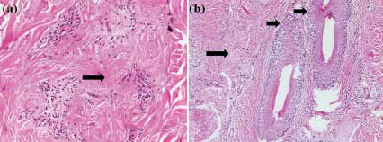 Lenfositik sikatrisyel alopesiler Kronik kütanöz lupus eritematozus (diskoid lupus eritematozus) Erken evrede dermoepidermal bileşkede ve folliküler infundibulumda vakuoler interfaz değişikliği