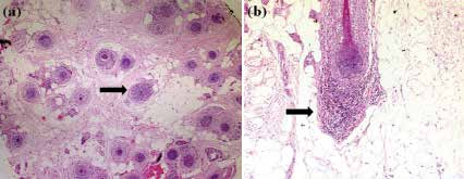 Perifolliküler ve perivasküler alanlarda, papiller ve retiküler dermiste lenfositik infiltrasyon ile dermal müsin birikimi izlenir 7,9.