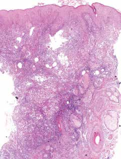 Türkderm 29 konsantrik lamellar fibroplazi, infundibulum ve istmusta perifolliküler lenfositik infiltrasyon ve infundibular füzyon izlenir 5,6.