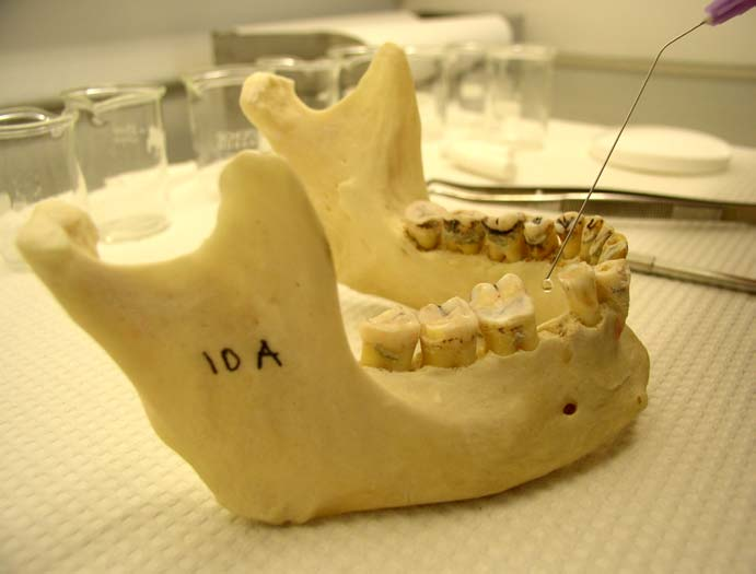 Alveoler soketin apeksine yerleştirilen pamuk peletler, ince uçlu bir enjektör yardımıyla 0,05 ml %70 lik perklorik asitle ıslatıldı (Resim 23).