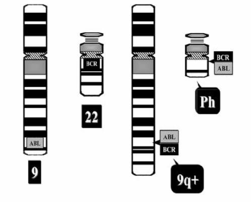 (BCR) geninin, bir araya gelmesi ile sonuçlandığı 1985 yılında gösterilmiģtir (ġekil.2.2.) (Abelson, HT, Rabstein LS, 1970, Jabbour E., Cortes J. E., Kantarjian H. M., 2009). ġekil.2.2.philadelphia kromozomu, t(9;22) (q34;q11) (Abelson, HT, Rabstein LS.
