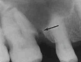 Kronik Maksiller Sinüs Açıklıkları (Oroantral Fistül) Kronik maksiller sinüs açıklıkları (KMSA) veya oroantral fistül (OAF) oluşumu diş çekiminin sık görülen komplikasyonlarıdır.