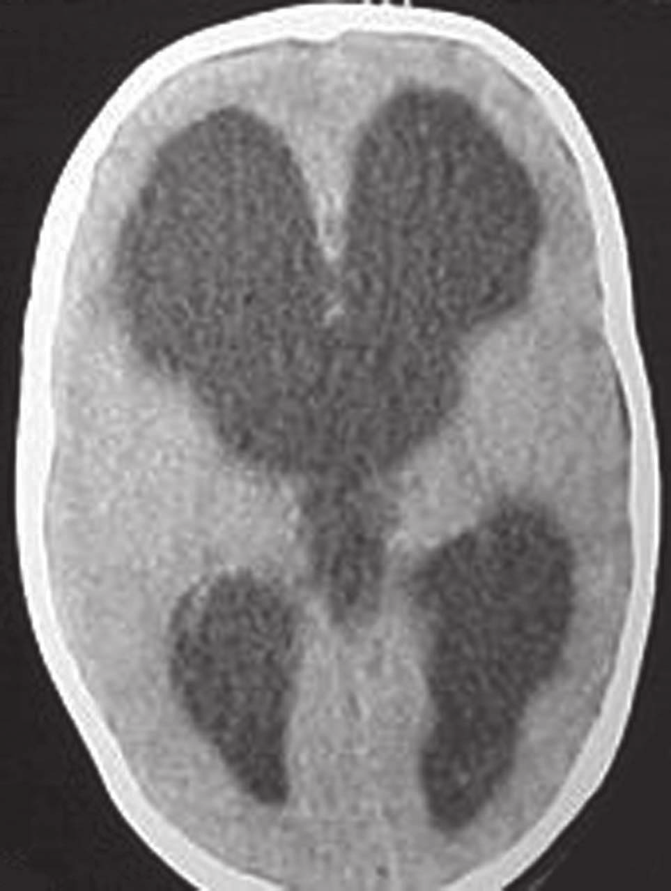 Șekil 3. Hidrosefalili bir olgunun bilgisayarlı beyin tomografisinde lateral ve üçüncü ventriküllerdeki dilatasyon izlenmektedir.