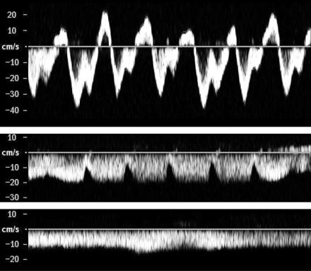 Doppler USG HV ler: Akım desenleri Tip 0: Trifazik Sirozlularda %50 Tip 1: Monofazik pulsatil