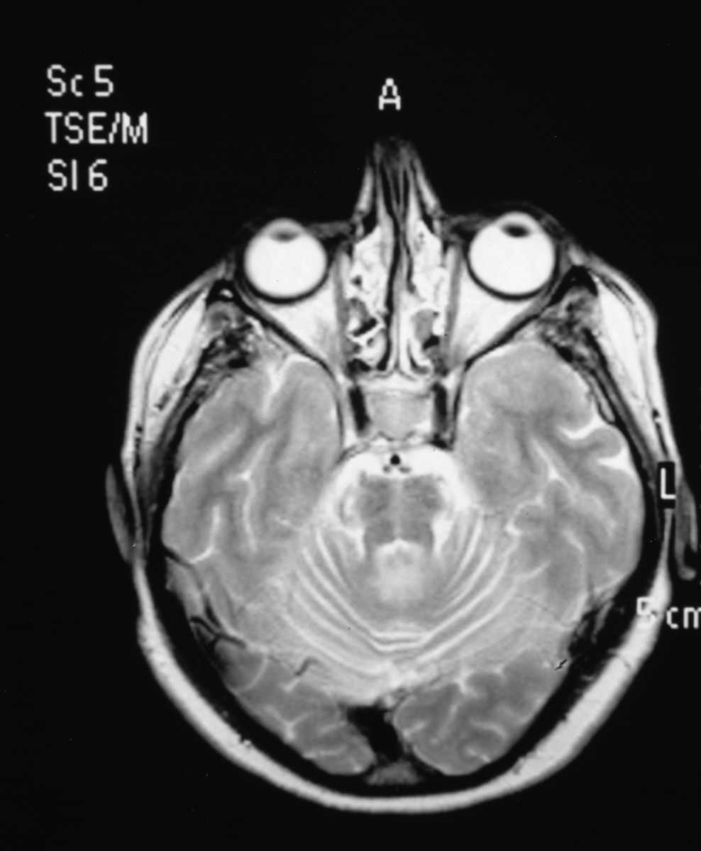 MULTIPLE SYSTEM ATROPHY: 5 CASES r ile iliflkili olabilece i düflünüldü.