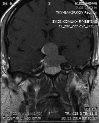 A: T ağırlıklı kontrastlı sagittal MR görüntüleme, B: T ağırlıklı kontrastlı koronal MR görüntüleme. Tablo. Mikroadenom < 0 mm, Makroadenom 0 mm, Dev adenom 40 mm.