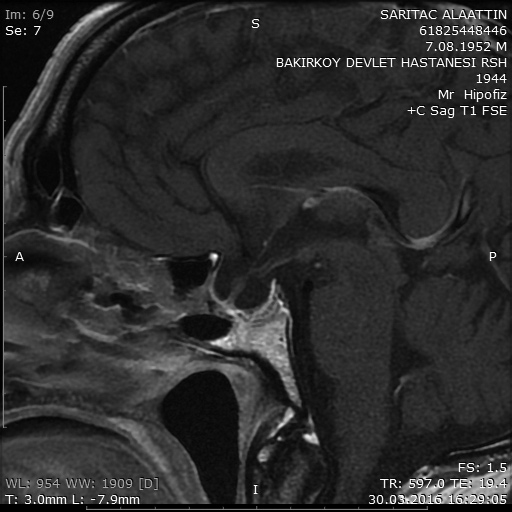 A:T ağırlıklı kontrastlı sagittal MR görüntüleme, B: T ağırlıklı kontrastlı koronal MR görüntüleme. 4 komplikasyonlarına bağlı nedenlerle kaybedildi.