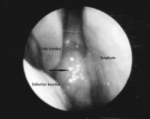 Adenoid Hipertrofisi Saptanan Erişkin Yirmi Üç Olgunun Analizi 47 Resim 1. a) Adenoid hipertrofisinin sağ endonazal endoskopik görünümü (siyah ok).