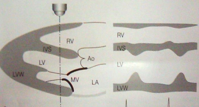 belirir. Kalp içindeki hareketli yapılar yatay eğriler, hareketsiz yapılar ise yatay düz çizgiler halinde gösterilir M-Mod ekokardiyografi tekniği 2-D görüntüleme klavuzluğunda kolaylıkla yapılabilir.