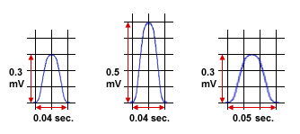 EKG nin II.derivasyonunda P dalgasının değişiklikleri Atriyal büyümeler Sol atrium büyümesi geniş P P mitrale (Köpekerde ve kedilerde P> 0.