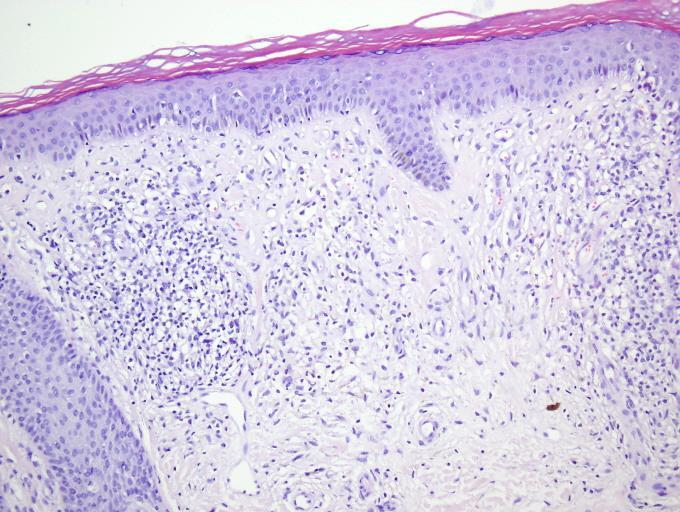 Epidermiste; hafif derecede spongiyozis,