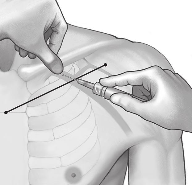 3. Medial ve orta üçte ikilik kısımların kesişiminde (nokta V) klaviküla üzerine işaret parmağınızı yerleştirin, bu noktanın altında subklavyen venin bulunması gerekir. 4.