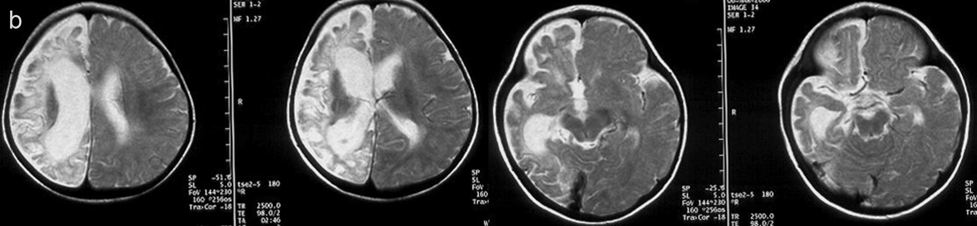 parahipokampal atrofi, 7 olguda (%44) ipsilateral serebral pedinkülde atrofi ve 3 olguda (%19) ipsilateral pons yarımında atrofi saptandı.