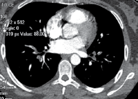 Toraks BT'sinde her iki akciğer ana pulmoner arterde, sağ akciğer üst ve alt lob, sol akciğer üst ve alt lob lober, segmental ve subsegmental pulmoner arter dallarında emboli ile uyumlu dolum defekti