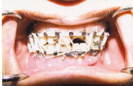 Hastanın intraoral muayenesinde sol alt kanin ve premolar dişler dışında dişlerinin olmadığı, mandibulanın aşırı hareketli olduğu ve hareket esnasında ağrı oluştuğu tespit edilmiştir.