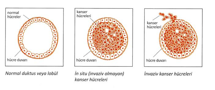 Kanser hücreleri, çevresindeki bazal hücreleri aştığında invaziv, aşmadığında ise In situ olarak adlandırılırlar. (Şekil 2.8) Şekil 2.8. İnvaziv ve In situ kanserleşme 2.2.2.4. Tanı Yöntemleri 2.2.2.4.1.