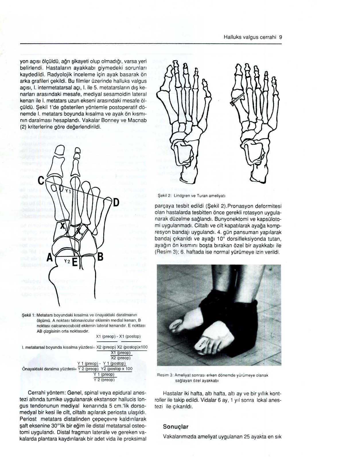 Halluks valgus cerrahi 9 yon açısı ölçüldü, ağrı şikayeti olup olmadığı, varsa yeri belirlendi. Hastaların ayakkabı giymedeki sorunları kaydedildi.