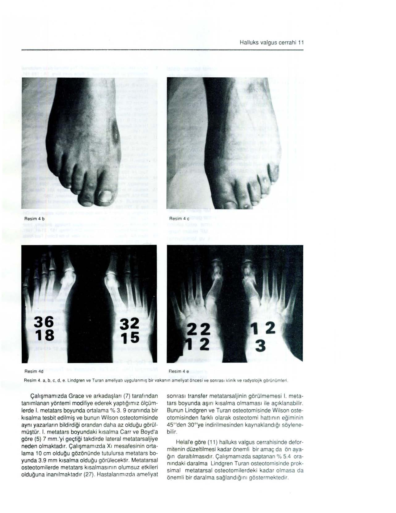 Halluks valgus cerrahi 11 Resim 4 b Re sim 4 C Resim t\d Fles im 4 e Resim 4. a, b, c, d, e. lindgren ve Turan a mel i yatı uyg ulanm ı ş bir vakan ı n ameliyat ö ~ c es i ve son r ası i<;!