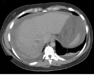 Maternal Komplikasyonlar Eklampsi (%4-9) Dekolman (%9-20) DIC (%5-56) ARY (%7-36) Şiddetli asit (%4-11) Serebral ödem (%1-8) Pulmoner ödem (%3-10) Kesi yeri hematomu/ infeksiyon