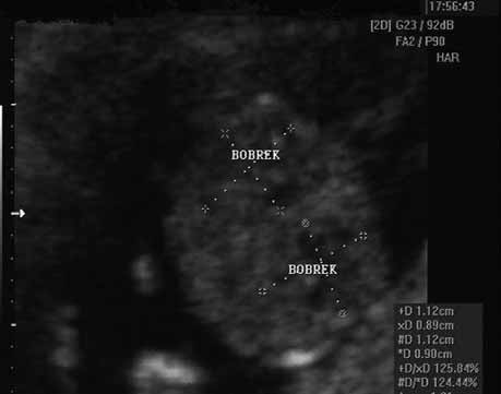 Birlikte olabilecek di er anomaliler: kalp, genital, yüz ve ekstremite defektleridir. 1 Otozomal resesif geçifl gösterir. Ailede etkilenmifl çocuk olmas durumunda tekrarlama riski %25 tir.