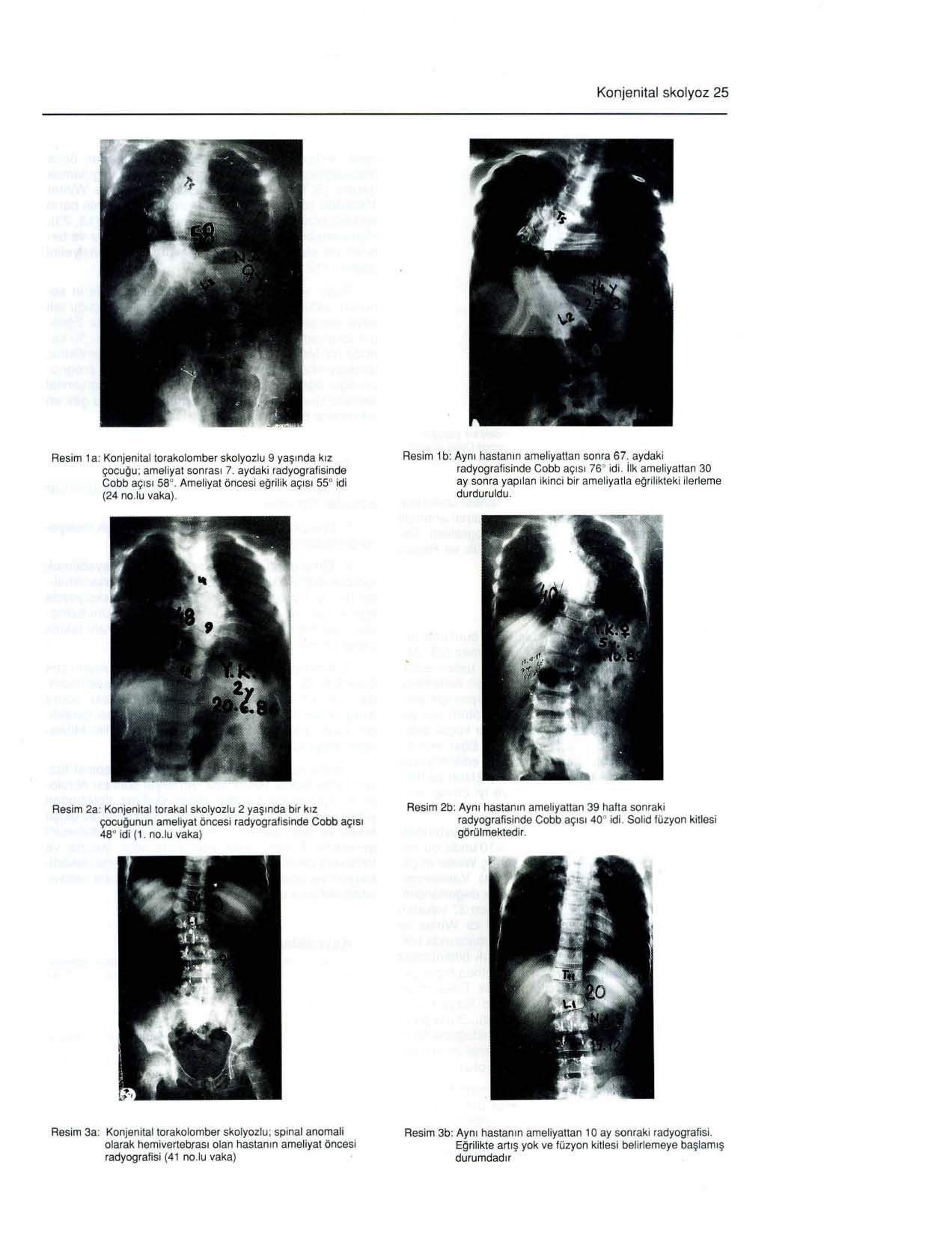 Konjenital skolyoz 25 Resim 1 a: Konjenital torakolomber skolyozlu 9 yaşında kız çocuğu ; ameliyat sonrası 7. aydaki radyografisinde Co bb açısı 58. Ameliyat öncesi eğrilik açısı 55 idi (24 no.