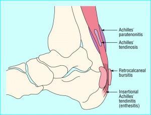 Tendon problemleri; İnsersiyonel tendinopati Tendonların kemiğe yapışma noktalarına yakın kısımlarında ortaya çıkan dejeneratif bir süreçtir.