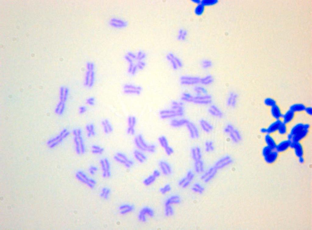 lenfositlerinde gözlenen kromozom anormallikleri a) kromatid
