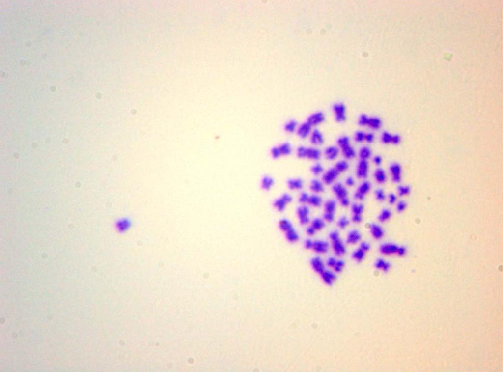 lenfositlerinde gözlenen kromozom anormallikleri a) kromatid