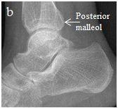 Anteroposterior görüntüler, medial ve lateral malleol, distal tibia veya fibula, plafond, talus superioru, gövde ya da lateral proçesi ve kalkaneus fraktürlerini gösterir.