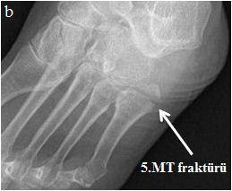 USG Fraktür yok Fraktür var Toplam n 110 0 110 % 99,1% 0% 84% n 1 20 21 % 0,9%