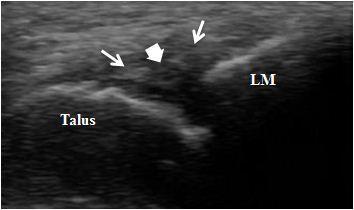 4.6). İnversiyon burkulmaları sırasında diğer sık yaralanan ligament ve tendonlar; 10 hastada (%41,6) PBt, 8 hastada