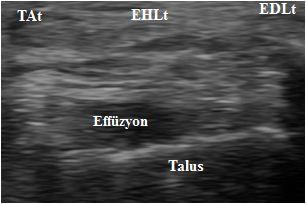 Şekil 4.8. USG görüntüsü: Anterior ayak bileği, transvers aks.
