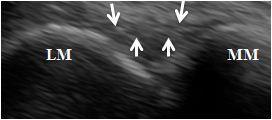 USG görüntüsü: Normal ATiFL görülüyor (oklar) Şekil 4.10.
