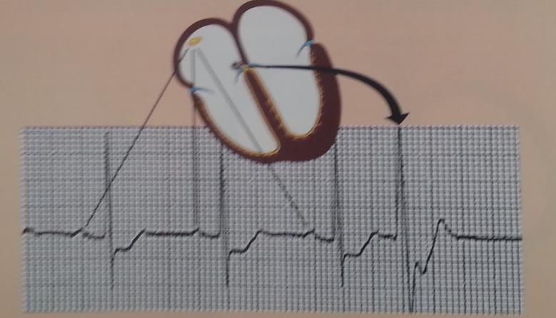 4 Şekil 5. Kavşak (Junctional) Erken Vuru Prematüre kavşak vuru, AKS, Digital kullanımı ve açık kalp operasyonlarından sonra karşımıza çıkabilir. Genelde semptom göstermez ve tedavi gerekmez. 1.